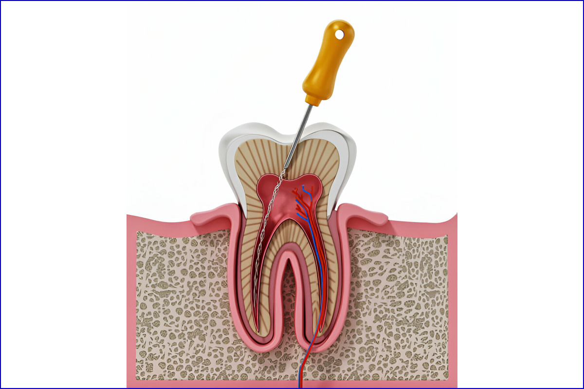 Best Dental Clinic for Root Canal Treatment (RCT) in Shela