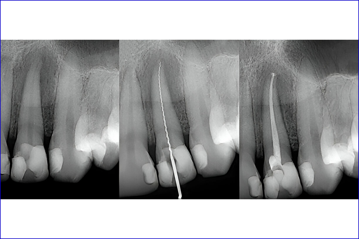 Best Dental Clinic for Root Canal Treatment (RCT) in Shela