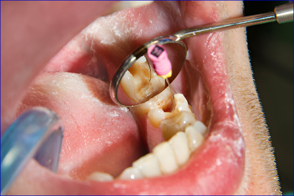 Best Dental Clinic for Root Canal Treatment (RCT) in Shela