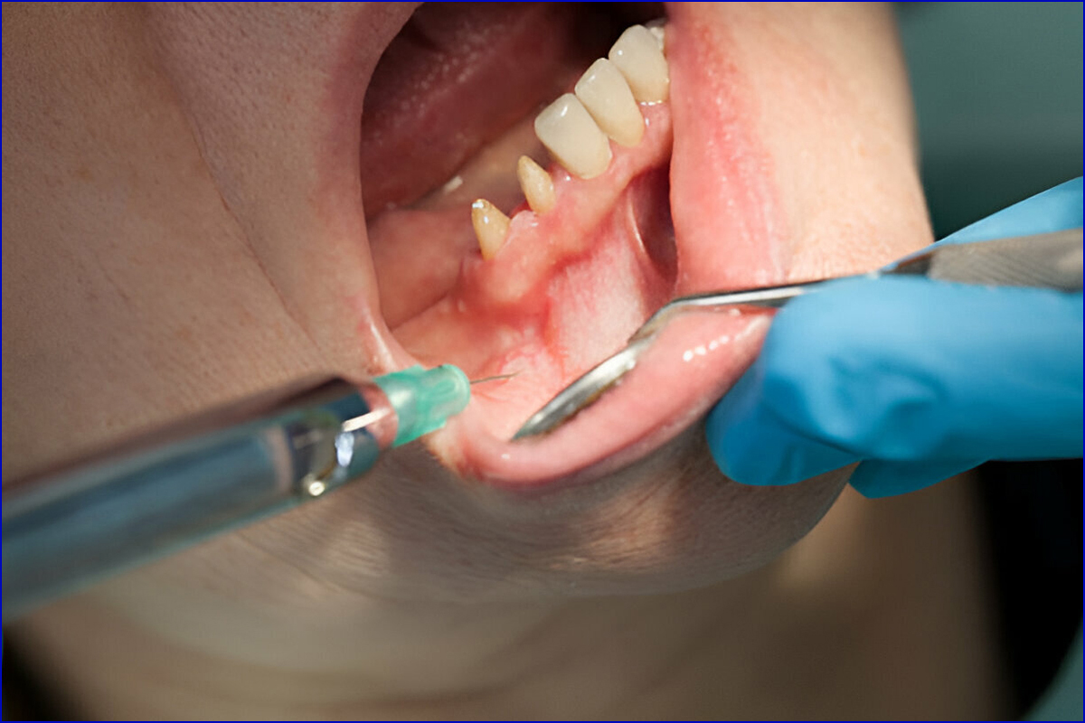 Best Dental Clinic for Periodontal Surgery in Shela