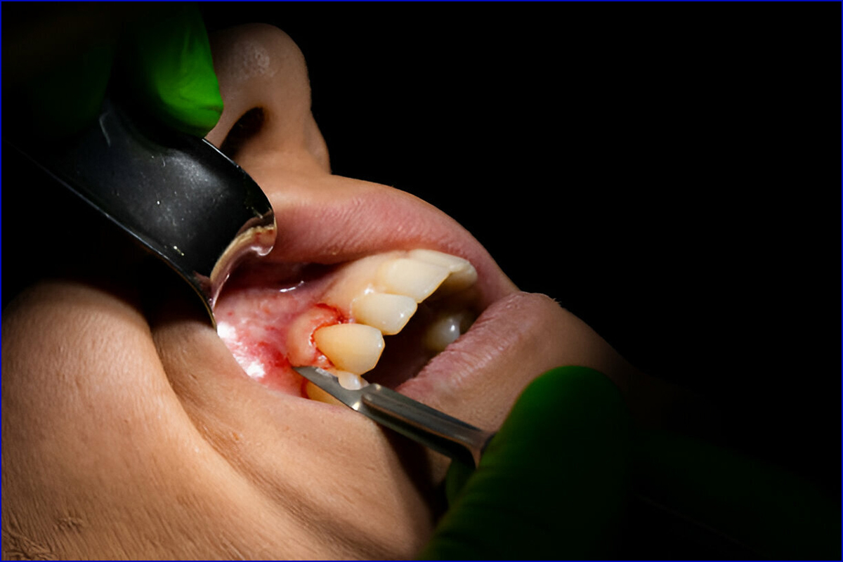 Best Dental Clinic for Periodontal Surgery in Shela